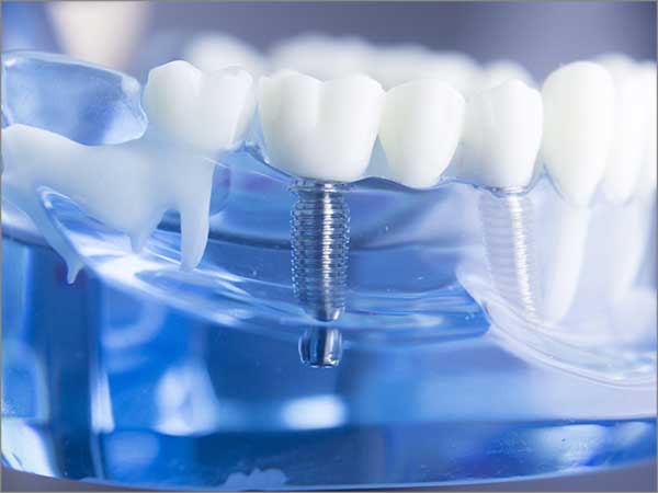 end-your-denture-problems-with-dental-implants