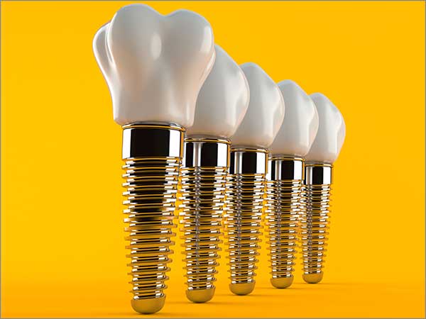 fabulous-five-facts-of-dental-implant-dental-implant-procedures