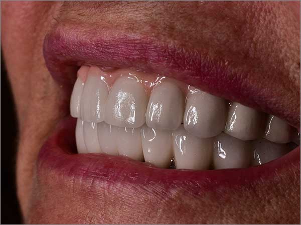 full-mouth-dental-implant