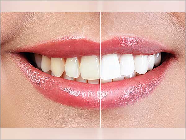 in-office-tooth-whitening