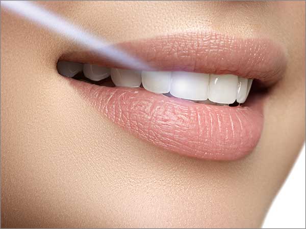 laser-teeth-whitening