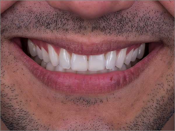 porcelain-veneers-images