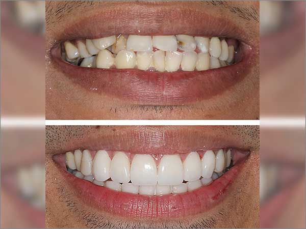 porcelain-veneers