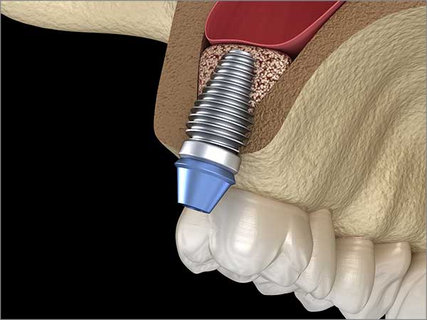 sinus-lift