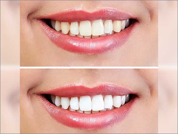 Teeth Whitening Treatment bangalore