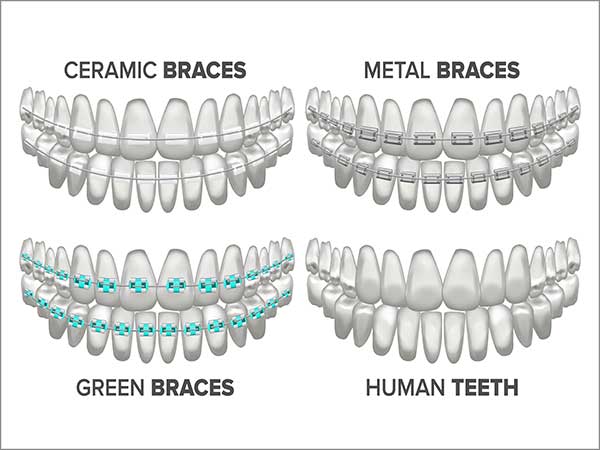 clear aligners in bangalore