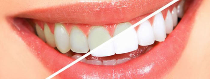 Office Tooth Whitening Treatment In Bangalore, India