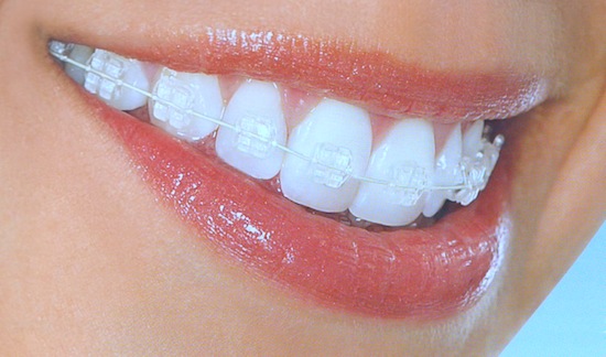 Ceramic Braces In Bangalore