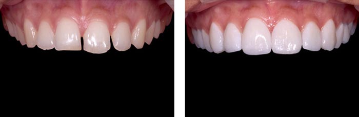 Porcelain Veneers In Bangalore