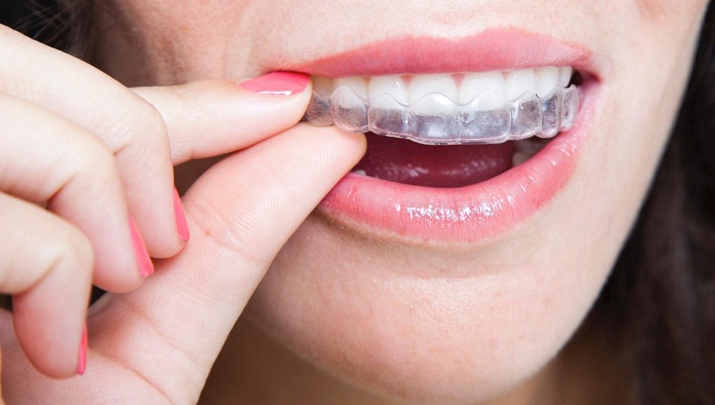 Invisalign-In-Bangalore