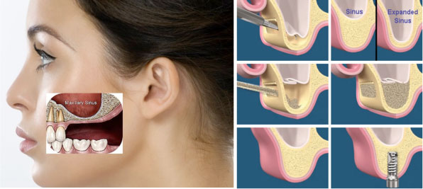 Sinus Lift Surgery In Bangalore