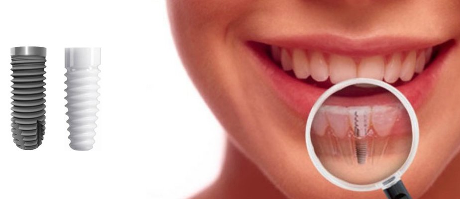 dental implants in bangalore, karnataka, india