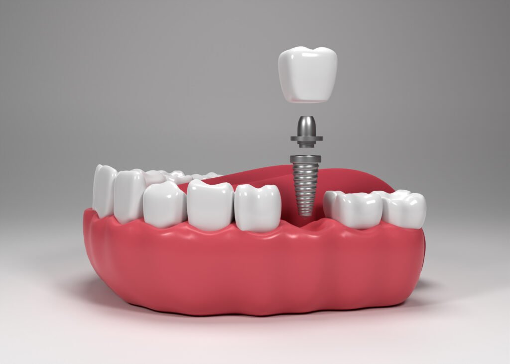 Best Dental Implants in Whitefield