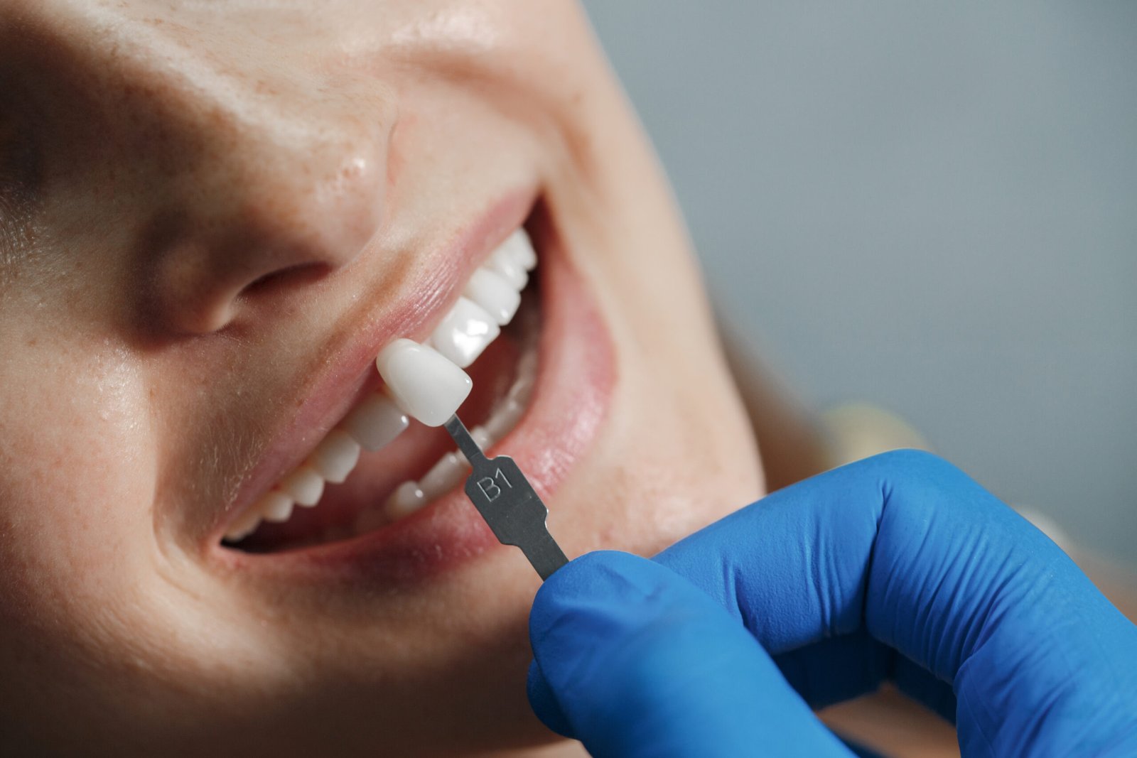 Best Dental Veneers in Mahadevapura