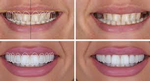Digital Smile Designing in Marathahalli – Advanced Smile Makeovers with Digital Precision