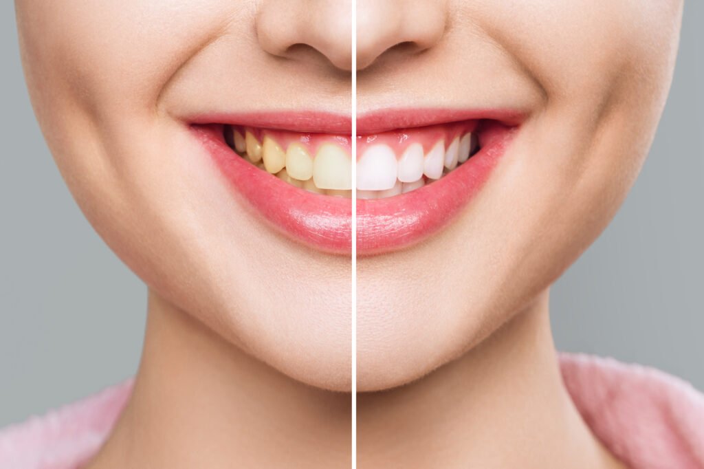 Teeth Whitening in Mahadevapura