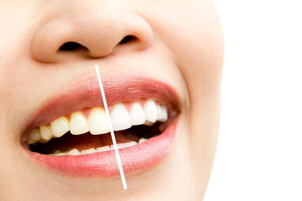 Teeth Whitening in Whitefield, Bangalore