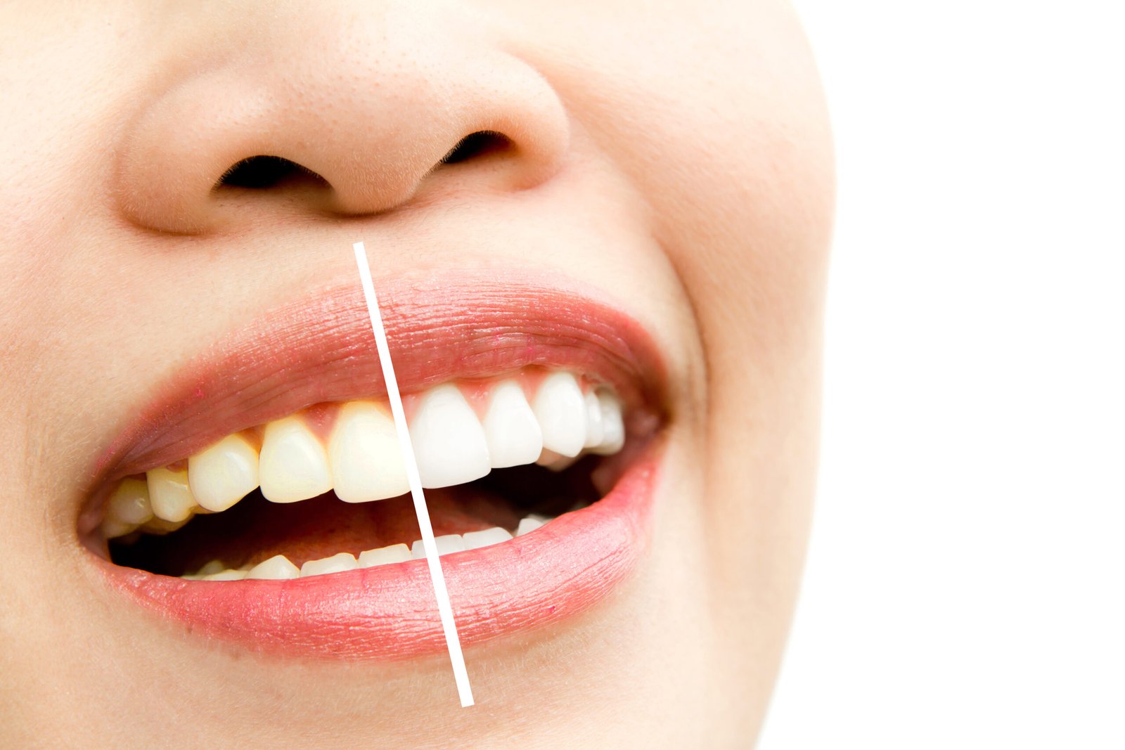 Teeth Whitening – Rediscover the Brightness Your Smile Deserves