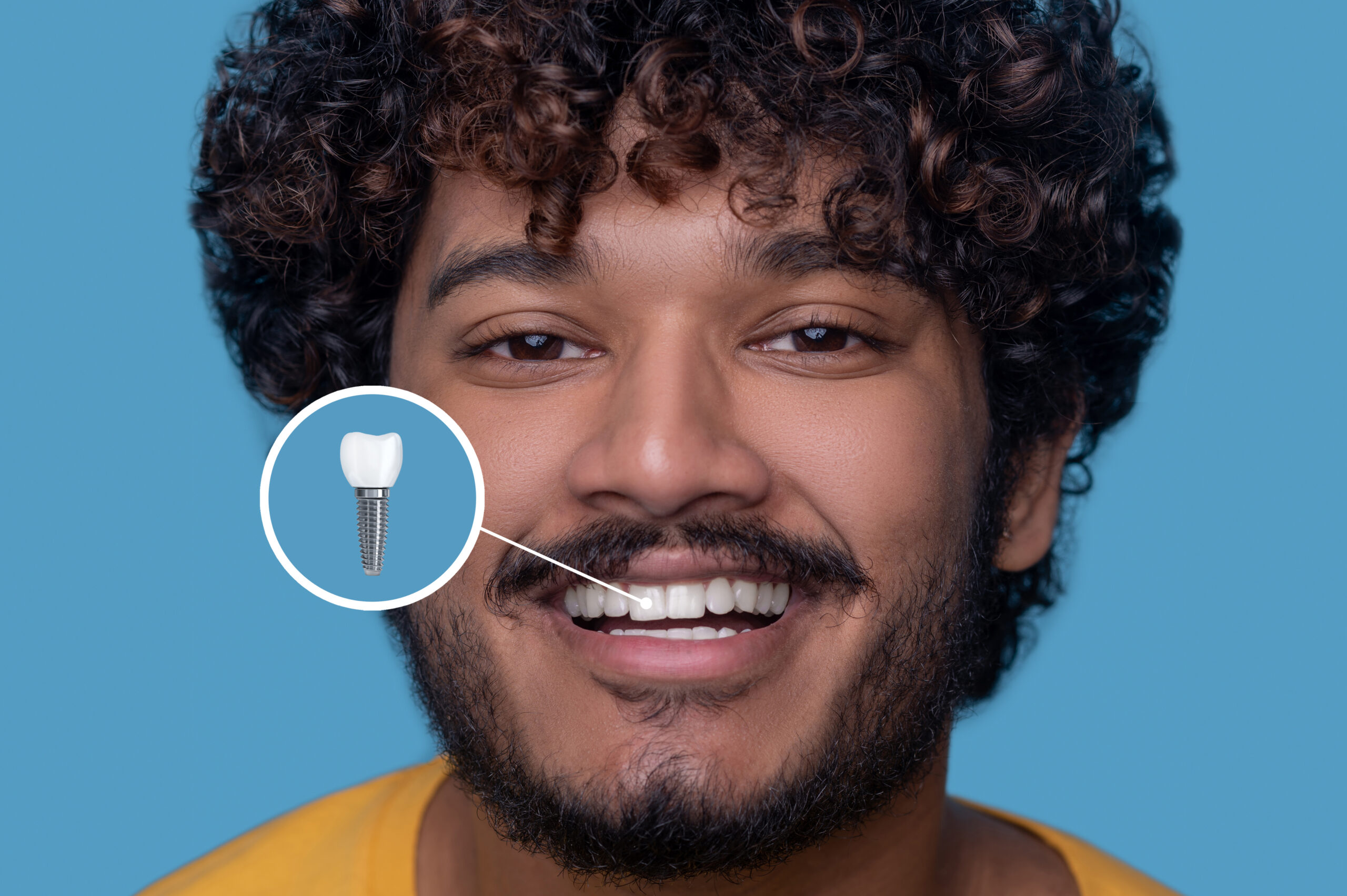 Are Dental Implants Worth It? The Complete Guide for Patients in Bangalore