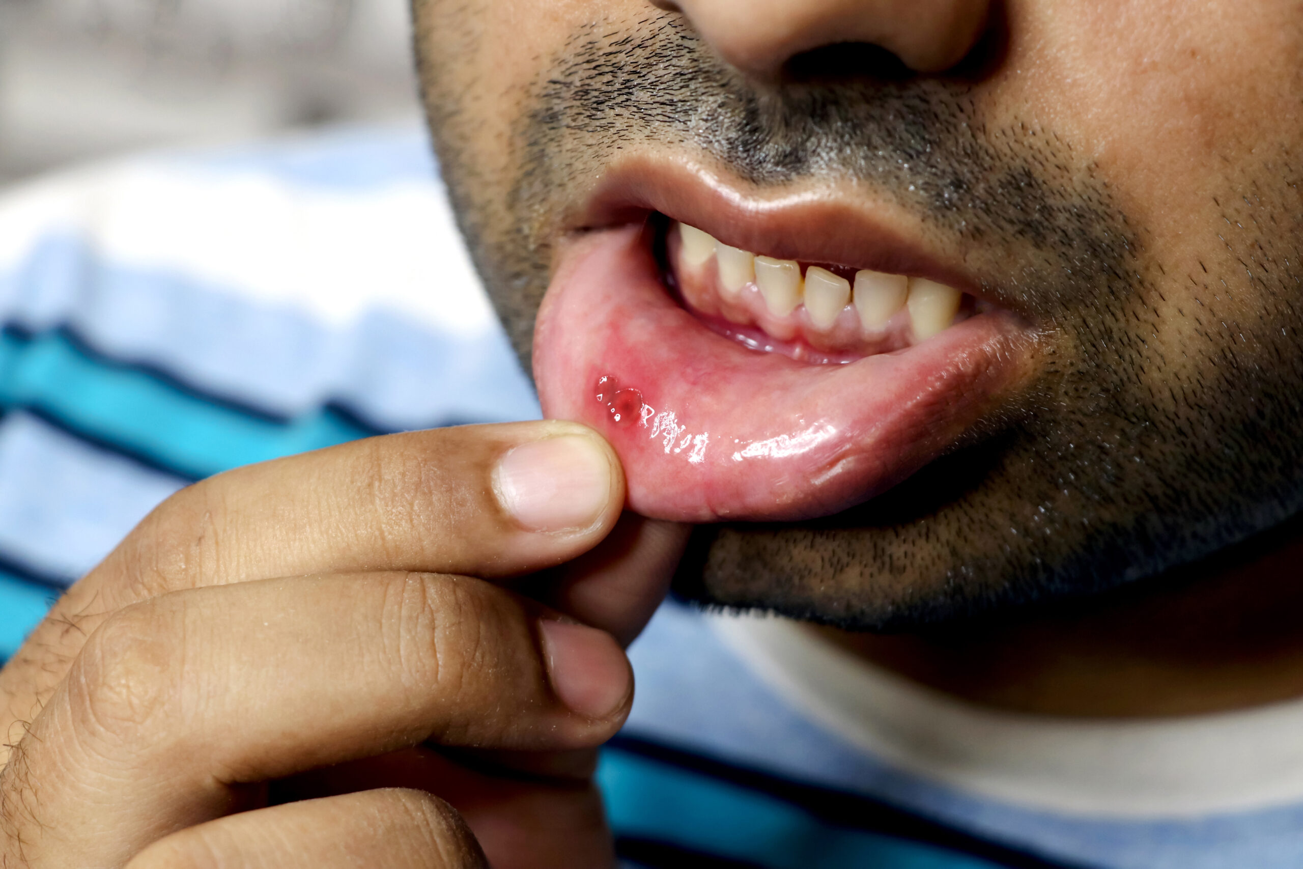 Mouth Ulcers and Sores: Causes, Relief, and When to See a Dentist