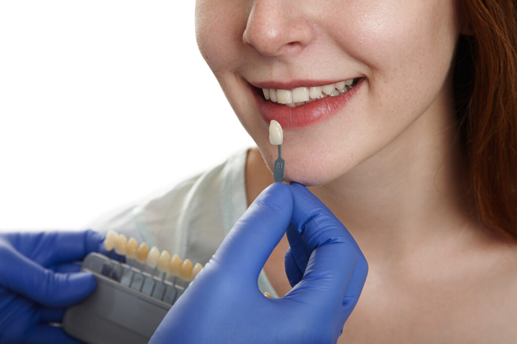 Dental Veneers AECS Layout